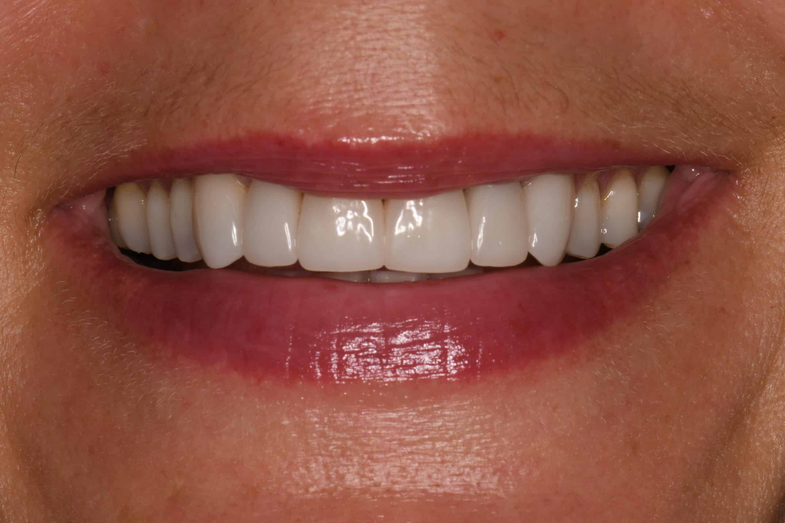 Smile after porcelain veneer treatment