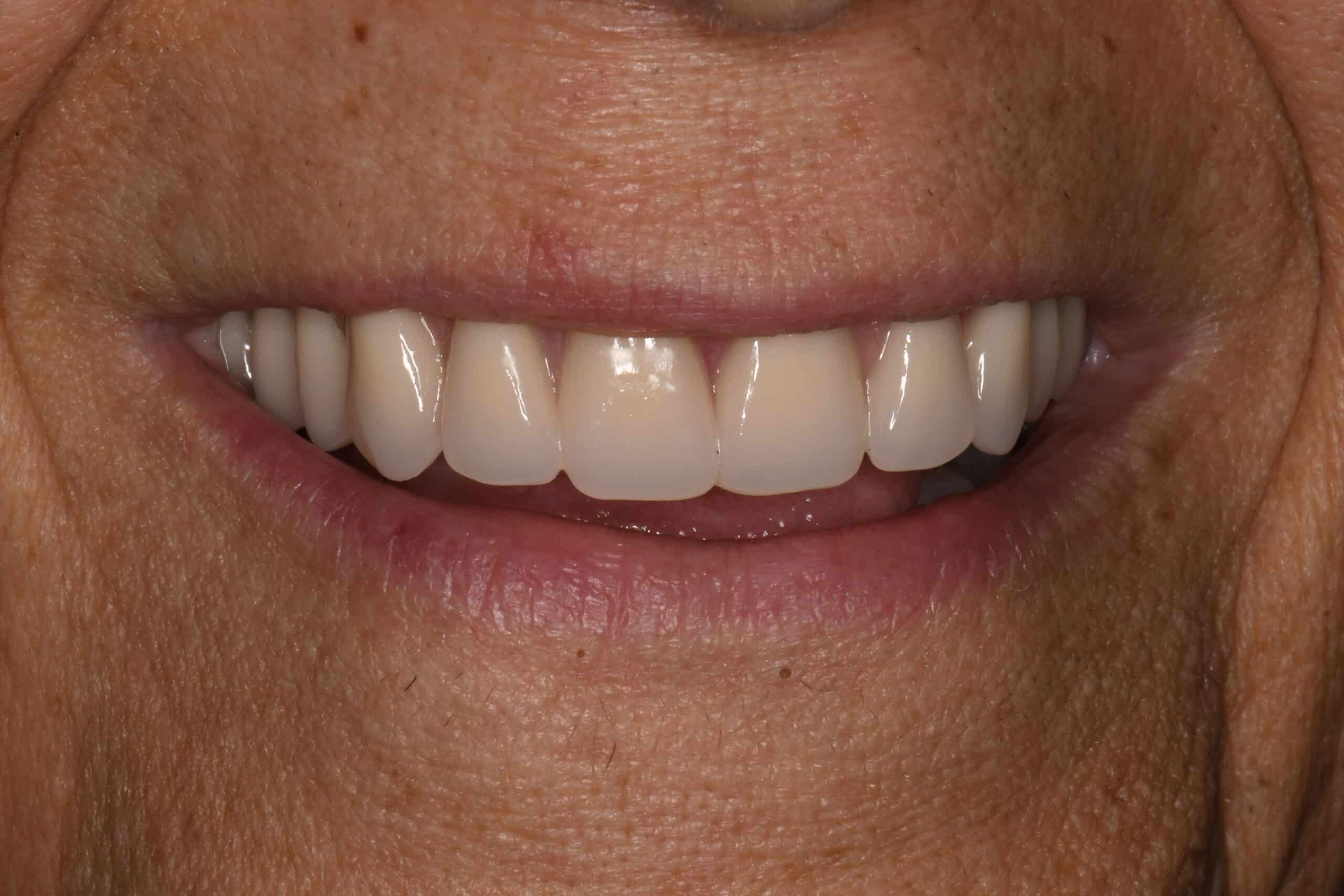 Smile after implant hybrid denture
