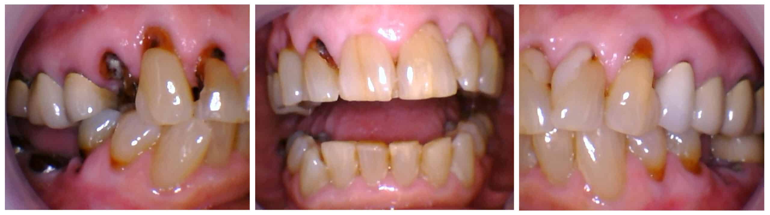 Smile before implant hybrid denture