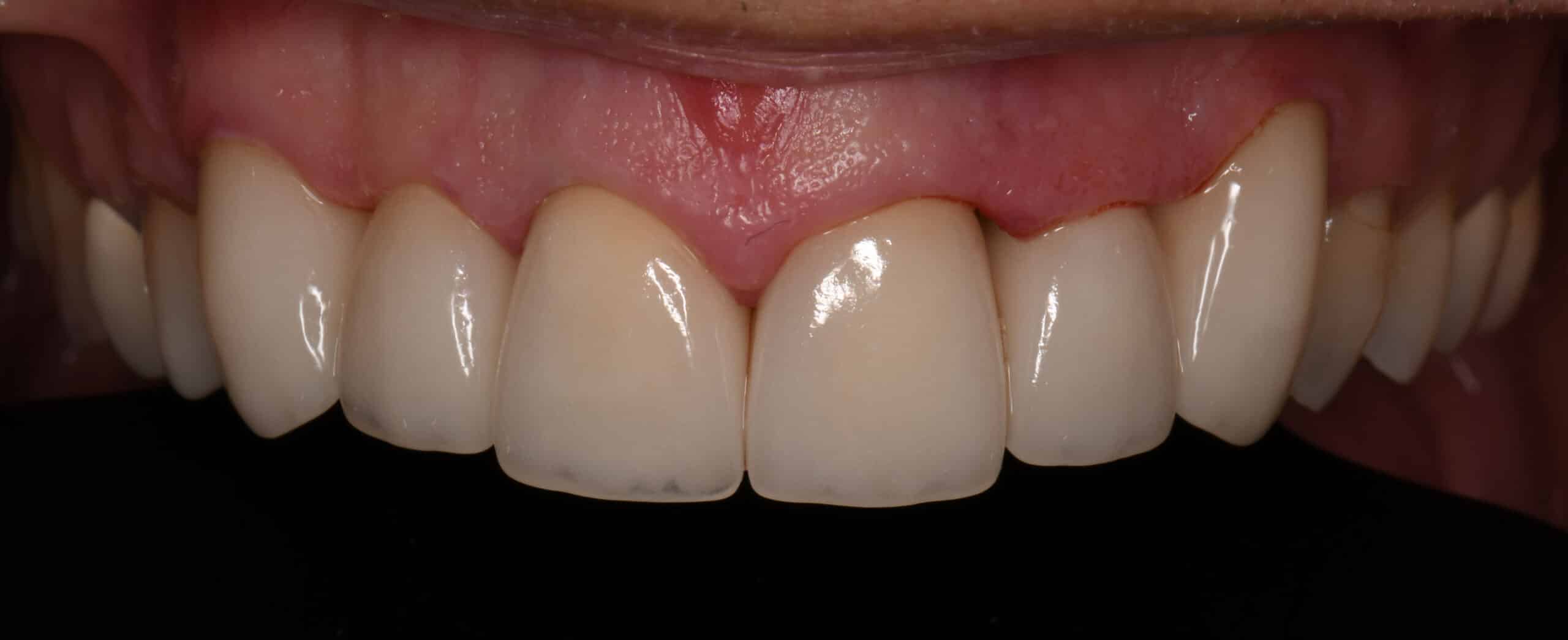 Smile after porcelain crowns