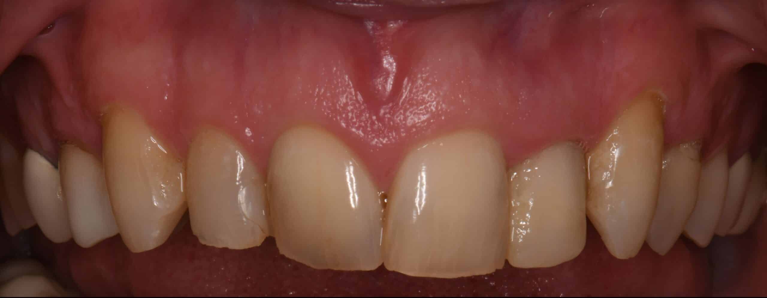 Smile before porcelain crowns