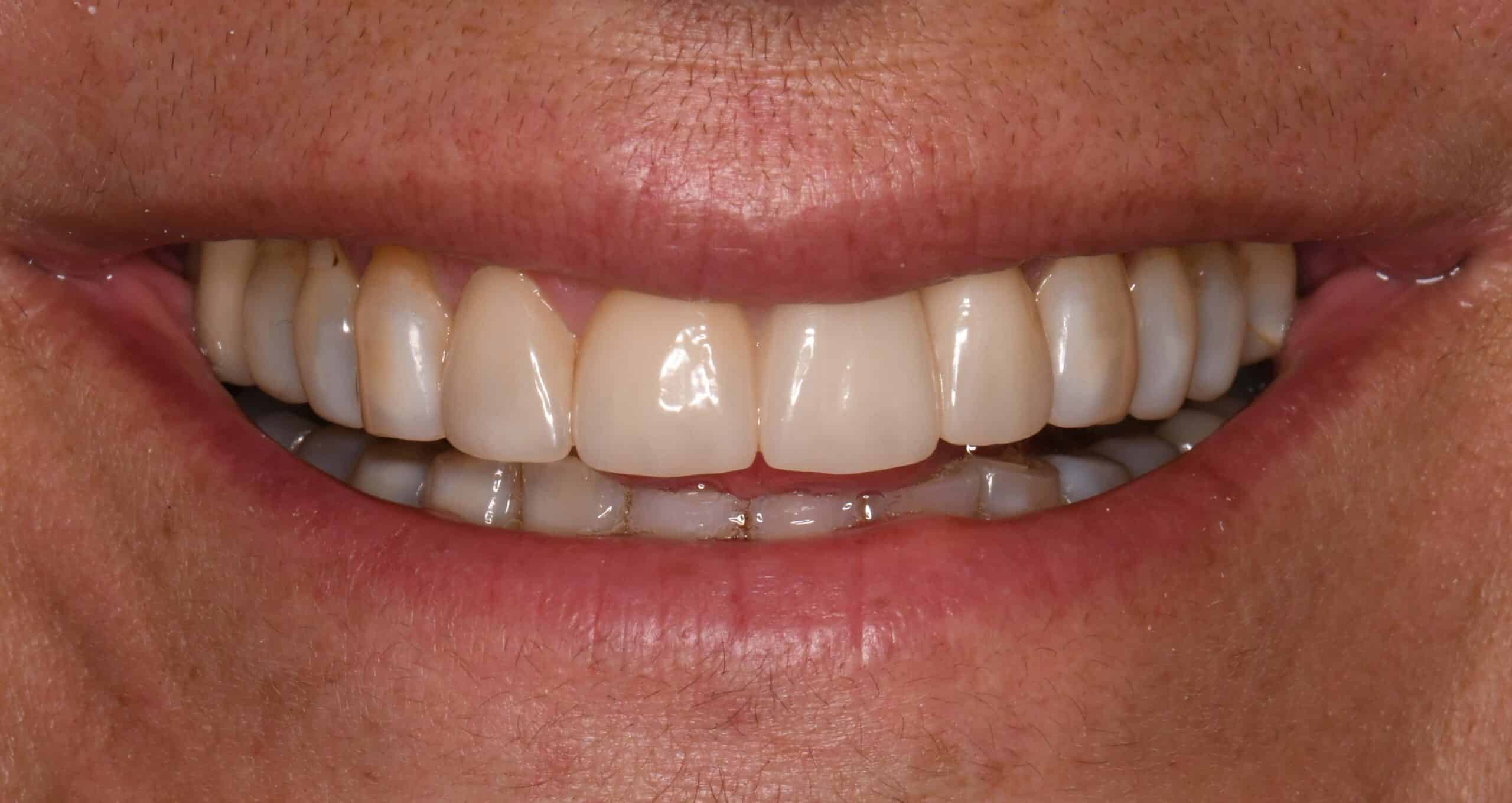 Smile after zirconia bridge