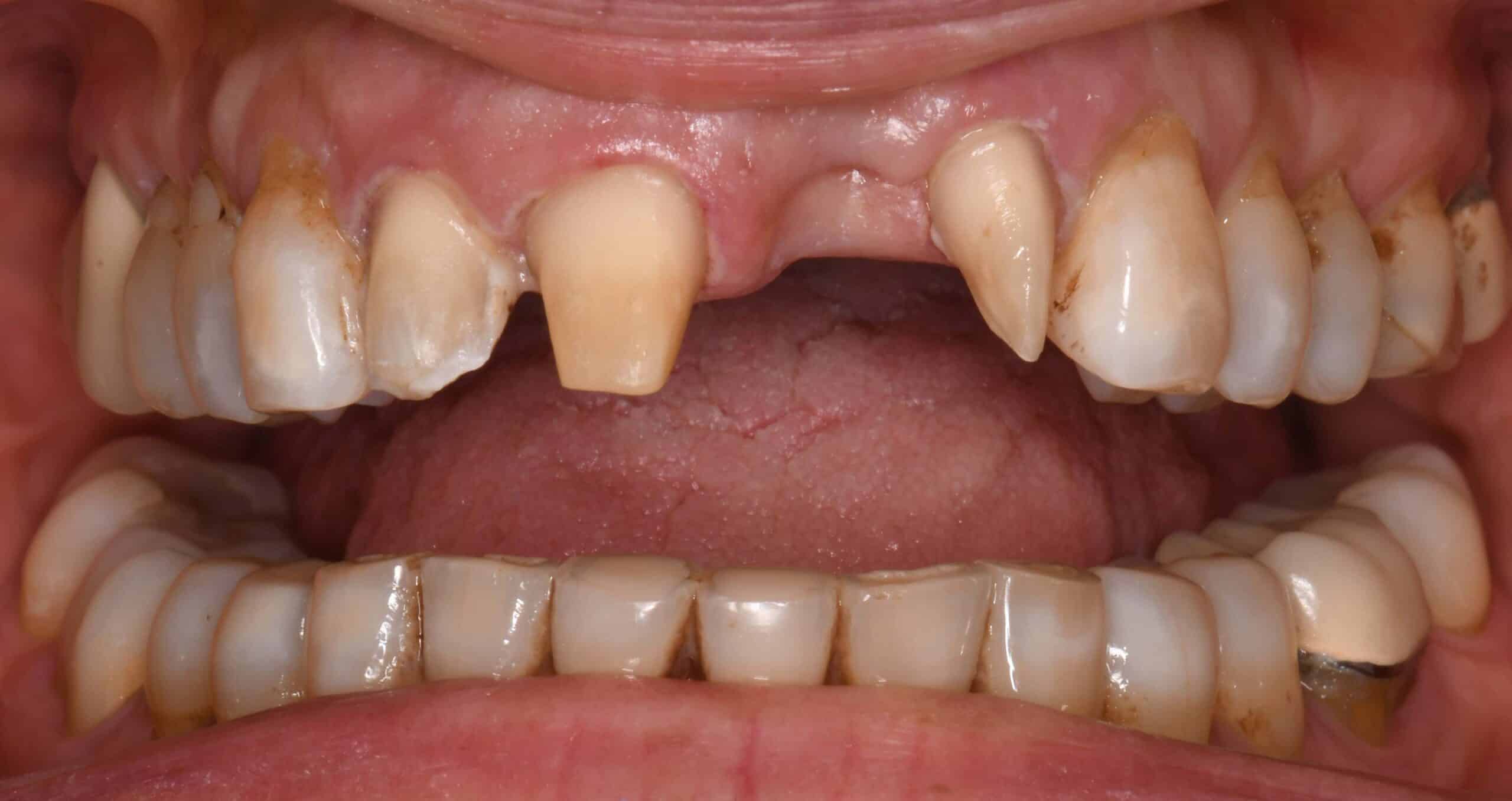 Smile before zirconia bridge