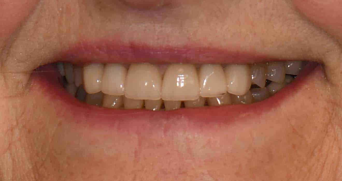 Smile after porcelain veneer treatment