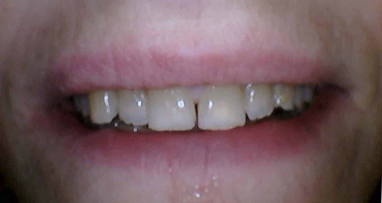 Smile before porcelain veneer treatment